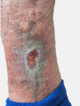 Venous Leg Ulcer