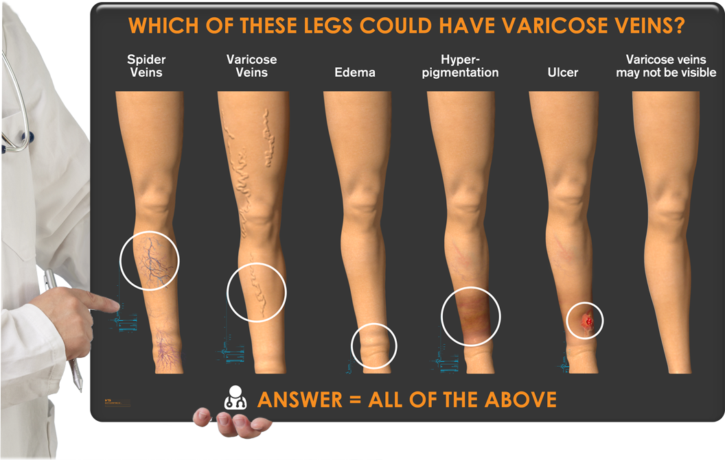 leg pain and restless legs often caused by varicose veins