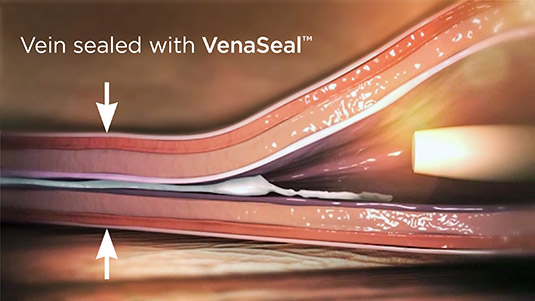 Vein sealed with VenaSeal