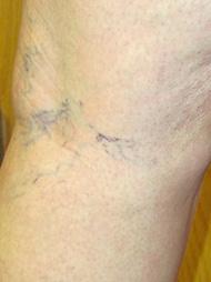 What are spider veins?