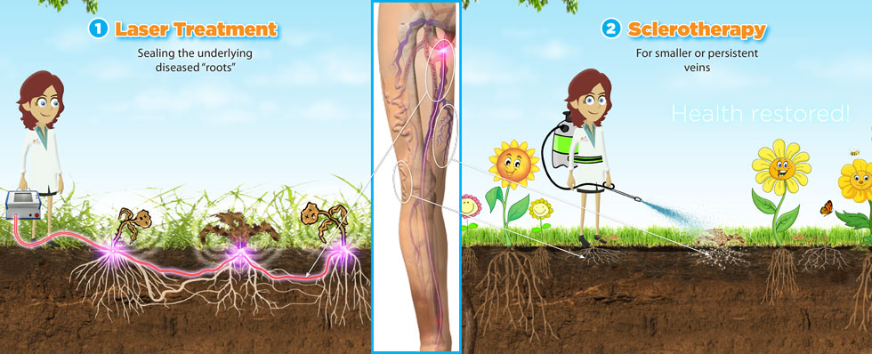 laser and sclerotherapy treatment