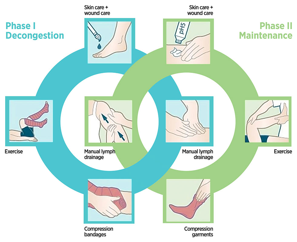 lymphedema complete decongestive therapy