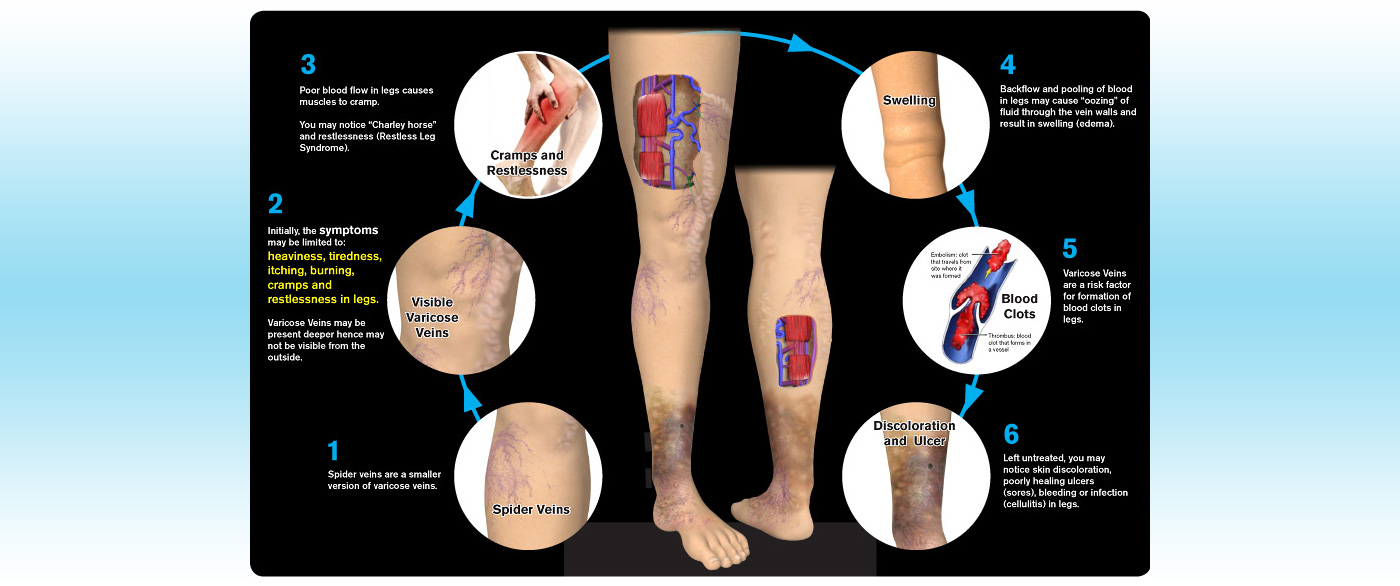 progression of varicose veins