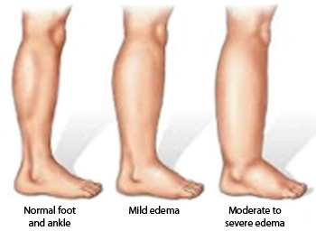 edema swelling