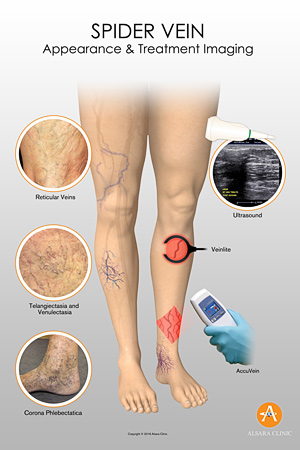 spider veins treatment