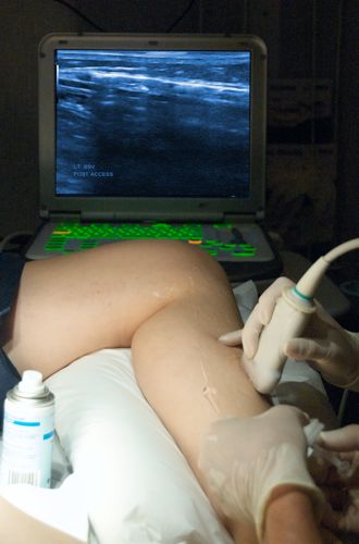 ultrasound guided sclerotherapy