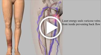 Laser Vein Treatment