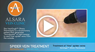 Spider Vein Treatment (short)