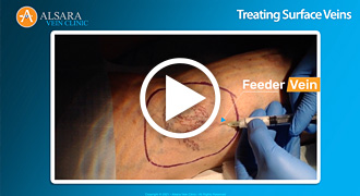Treating Surface Veins (short)