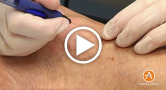 VeinGogh Spider Treatment 2