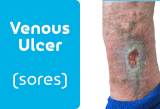 Leg Ulcers (sores)