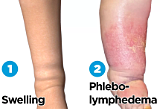 Swelling (edema and lymphedema)